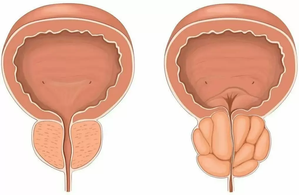 Prostatitis y próstata sana