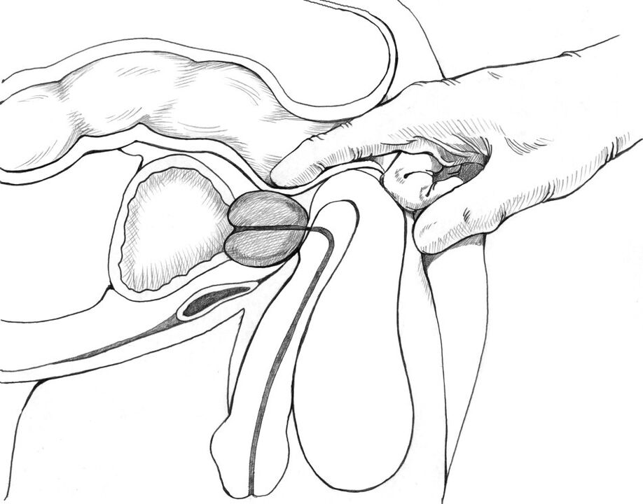 El masaje de próstata está incluido en el complejo de métodos de tratamiento de la prostatitis.