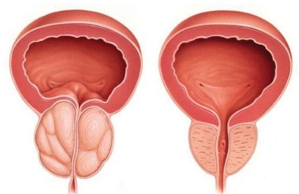 próstata normal y agrandada con prostatitis